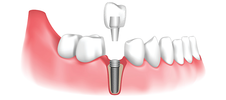 Dental Implant Procedures - American Academy of Periodontology