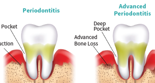 gum disease graphic